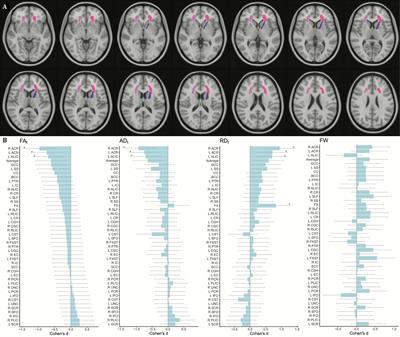 Microstructural White Matter and Links With Subcortical Structures in Chronic Schizophrenia: A Free-Water Imaging Approach